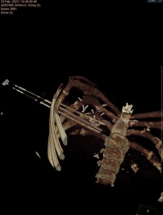 FOTO 1 INTERVENTO RADIOLOGIA ROBOT ASSISTITO