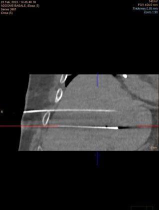 FOTO 2 INTERVENTO RADIOLOGIA ROBOT ASSISTITO