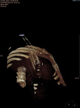 FOTO 3 INTERVENTO RADIOLOGIA ROBOT ASSISTITO